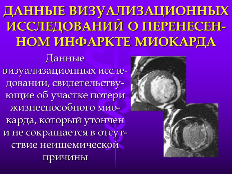 ДАННЫЕ ВИЗУАЛИЗАЦИОННЫХ ИССЛЕДОВАНИЙ О ПЕРЕНЕСЕН-НОМ ИНФАРКТЕ МИОКАРДА Данные визуализационных иссле-дований, свидетельству-ющие об участке потери